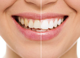 Teeth whitening (at-home)