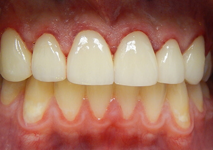 After photo of teeth