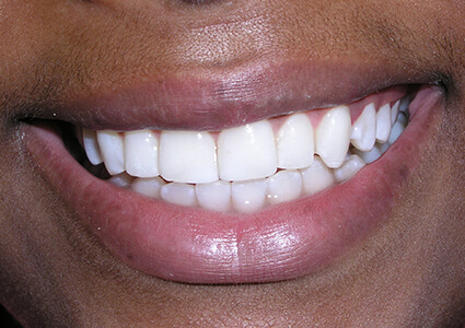 After photo of teeth