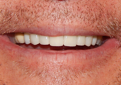 After photo of teeth