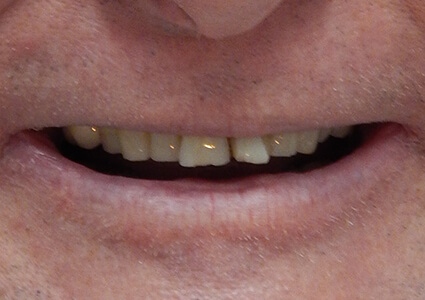 Before photo of teeth