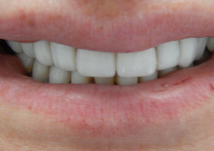 After photo of teeth