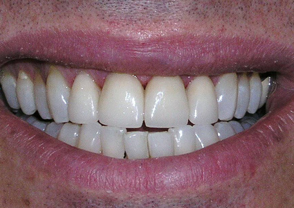 After photo of teeth