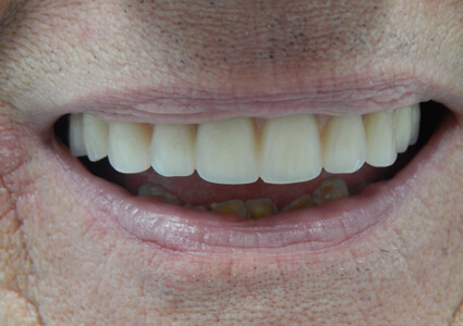 After photo of teeth