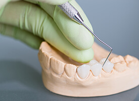 Dental bridges