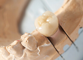 Dental crowns and bridges