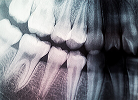 Digital x-rays of teeth