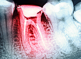 Root canal